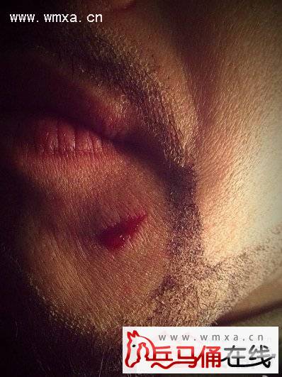 何润东手臂受伤打石膏 明星拍戏光鲜背后受伤是家常便饭