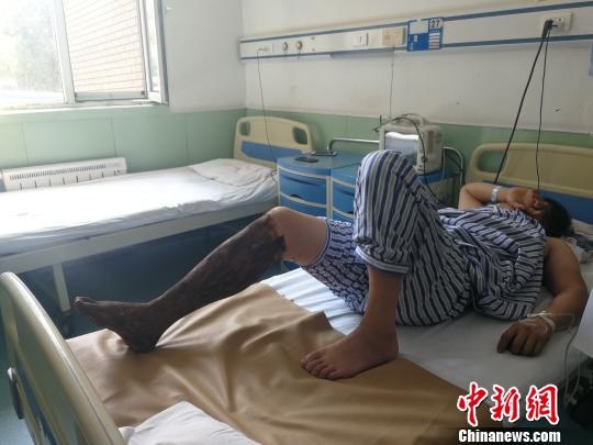 7月2日上午,山西榆次的郭先生正躺在病床上接受治疗,被毒蛇咬伤的右腿涂抹了蛇药,但依旧肿胀明显。 范丽芳 摄